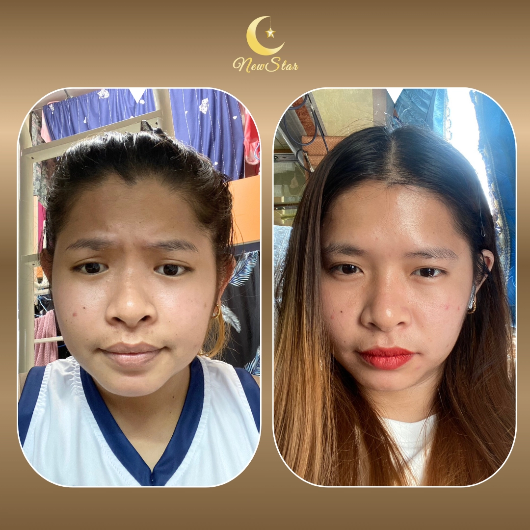 โบท็อกซ์เกาหลี NABOTA