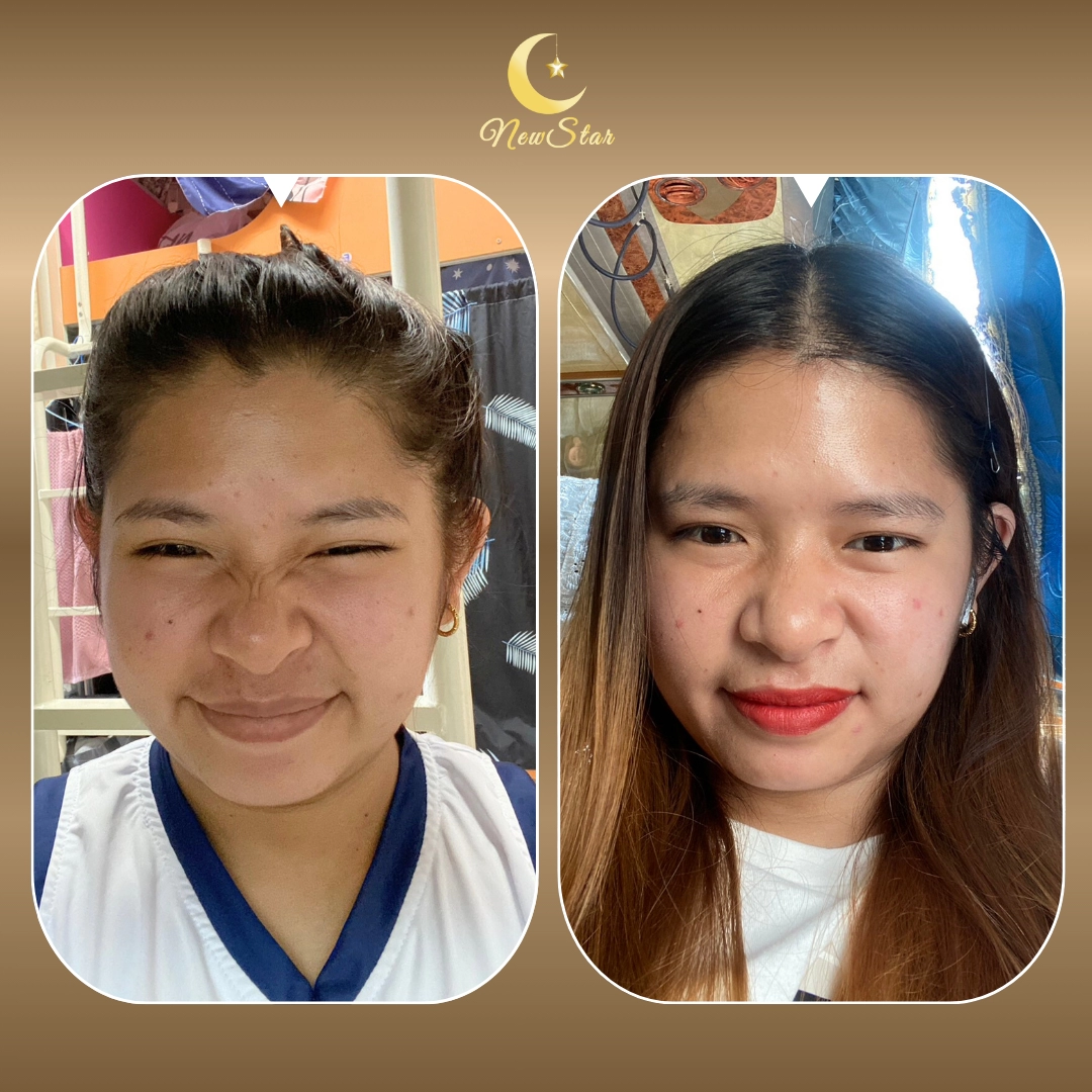 โบท็อกซ์เกาหลี NABOTA