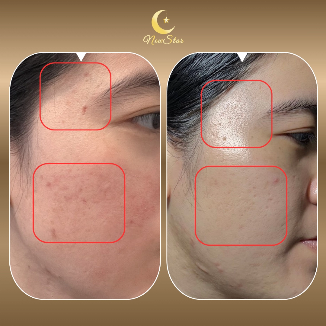 PICOBEE เลเซอร์หลุมสิว