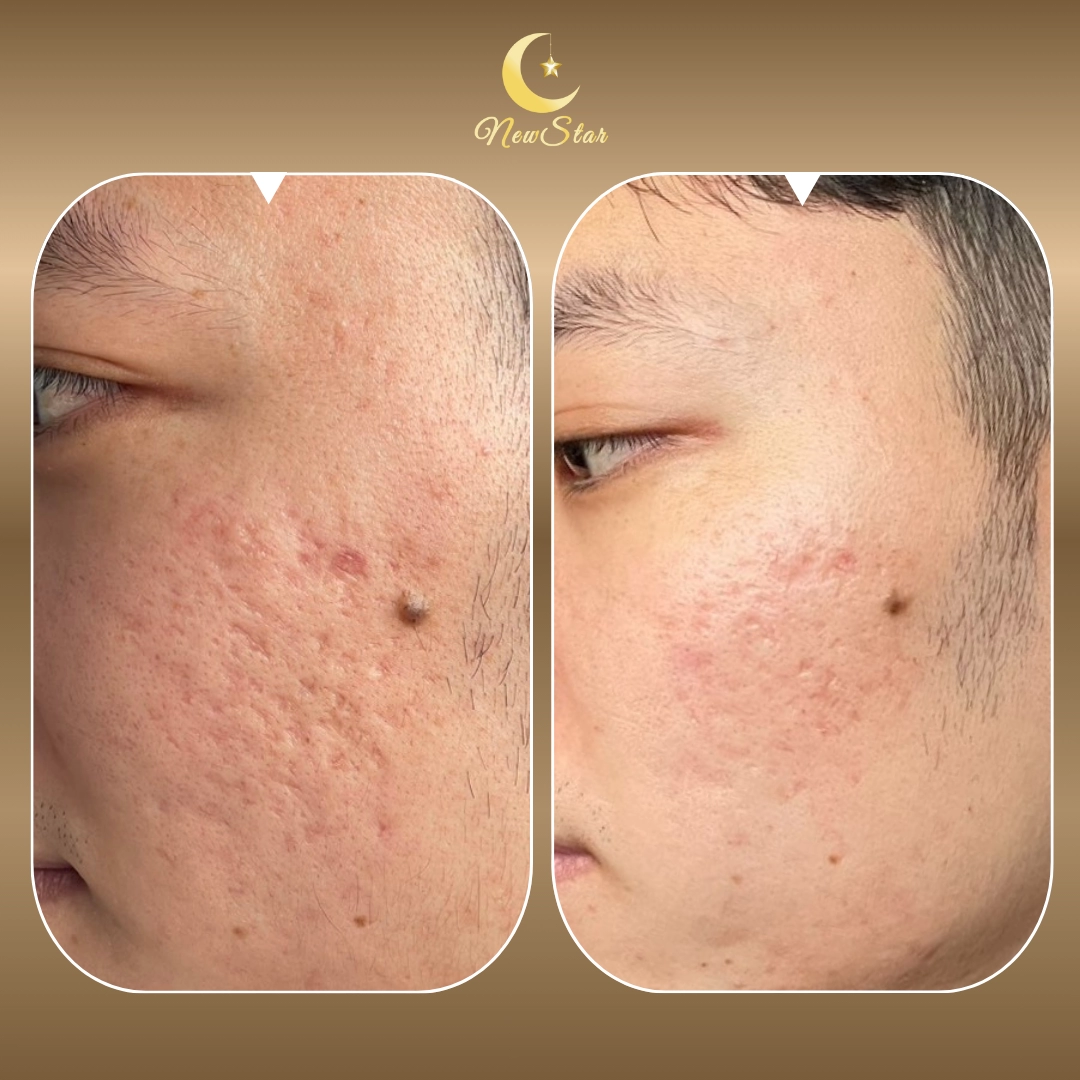 PICOBEE เลเซอร์หลุมสิว